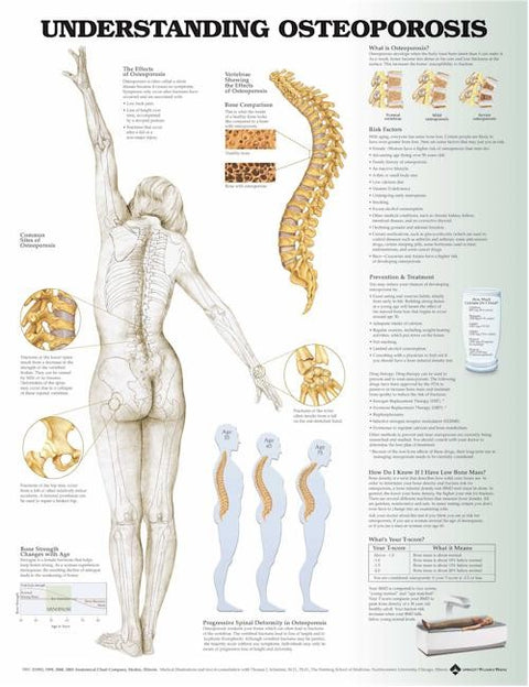 Understanding Osteoporosis(Poster Size)